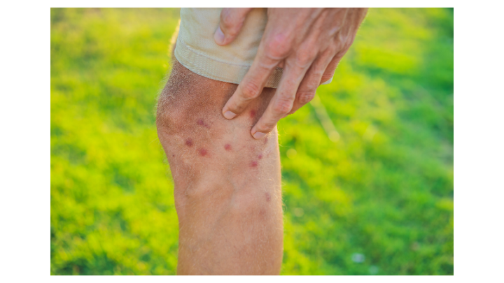 homme ayant été piqué par des insectes